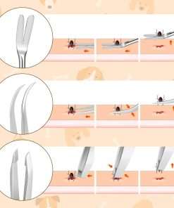 Rypet Tick Remover Tool Set - Stainless Steel Tick Remover Kit for Cats Dogs and Humans(Pack of 3) - 4